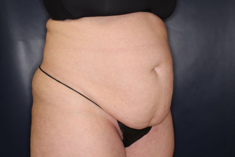 Liposuction Before & After Image