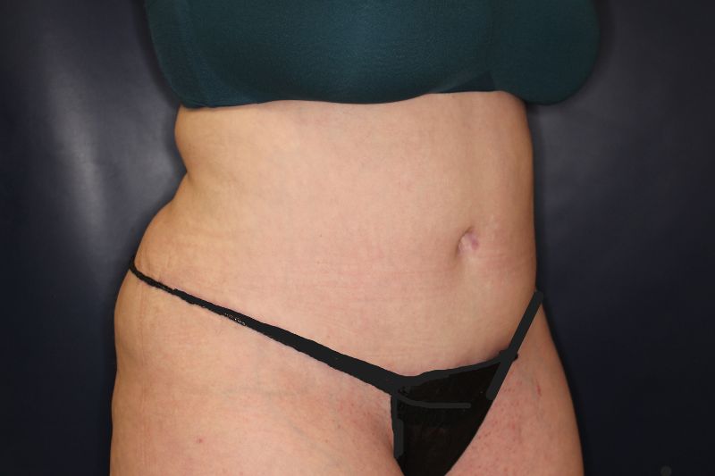 Liposuction Before & After Image