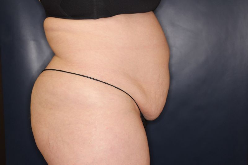 Liposuction Before & After Image