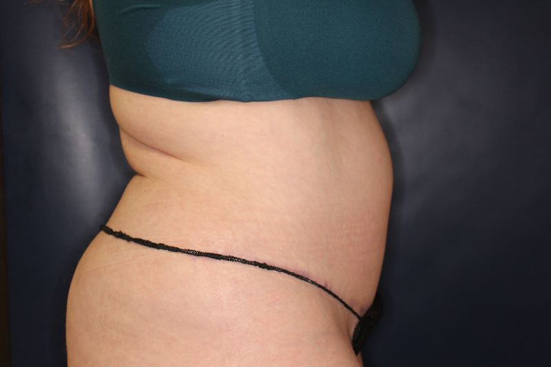 Liposuction Before & After Image