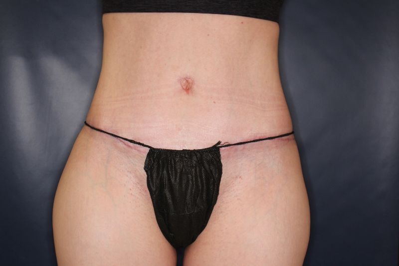 Liposuction Before & After Image