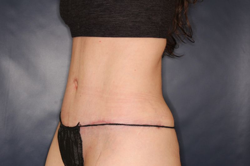 Liposuction Before & After Image