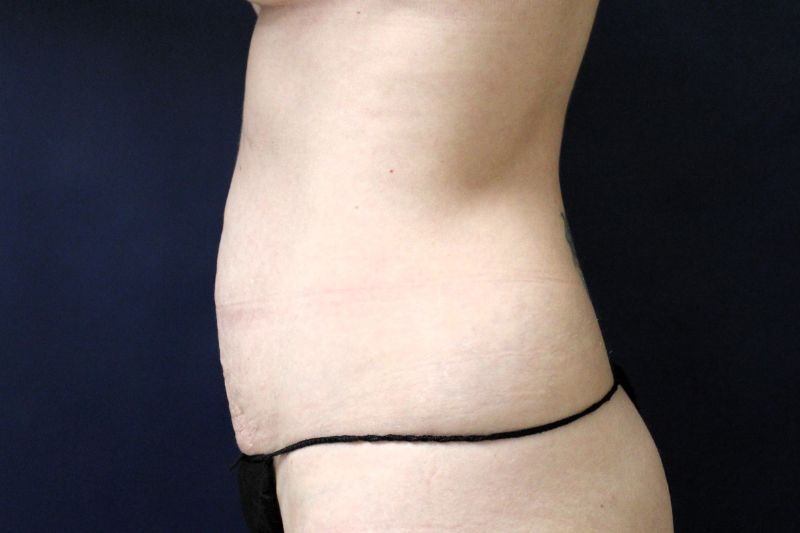 Liposuction Before & After Image