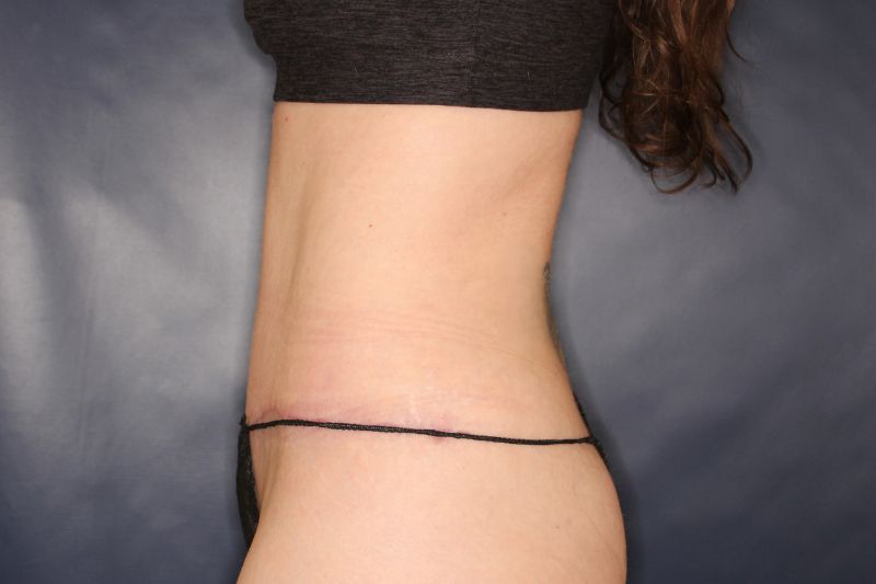 Liposuction Before & After Image