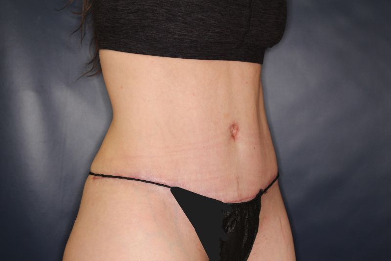 Liposuction Before & After Image