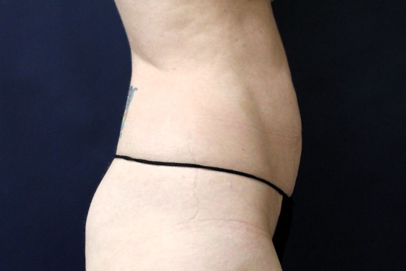 Liposuction Before & After Image