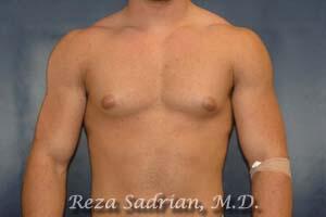 Male Body Enhancement Before & After Image