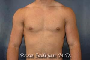 Male Body Enhancement Before & After Image