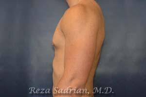 Male Body Enhancement Before & After Image