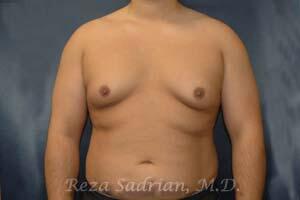 Male Body Enhancement Before & After Image