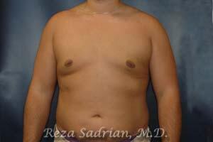 Male Body Enhancement Before & After Image