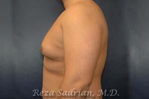 Male Body Enhancement Before & After Image