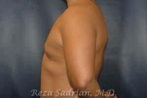 Male Body Enhancement Before & After Image