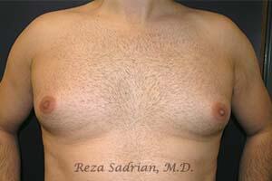 Male Body Enhancement Before & After Image