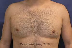 Male Body Enhancement Before & After Image