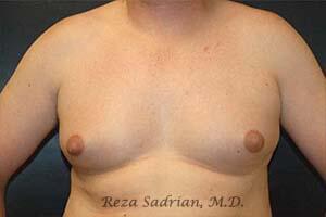 Male Body Enhancement Before & After Image