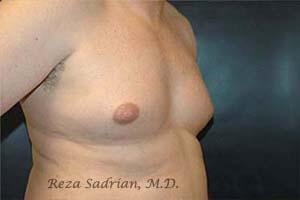 Male Body Enhancement Before & After Image