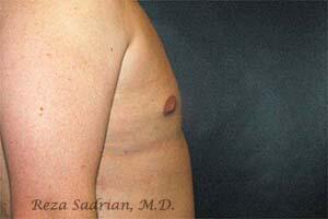 Male Body Enhancement Before & After Image