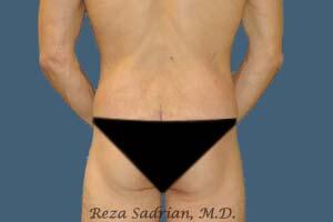 Male Body Enhancement Before & After Image