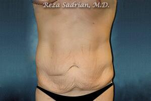 Male Body Enhancement Before & After Image