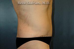 Male Body Enhancement Before & After Image