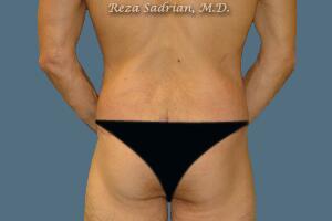 Male Body Enhancement Before & After Image