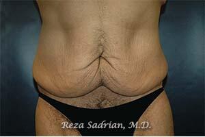 Male Body Enhancement Before & After Image