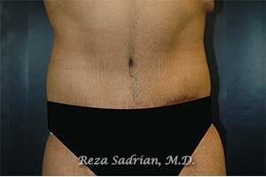 Male Body Enhancement Before & After Image