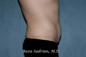 Male Body Enhancement Before & After Image