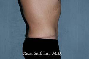 Male Body Enhancement Before & After Image