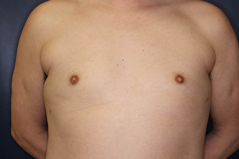 Male Body Enhancement Before & After Image