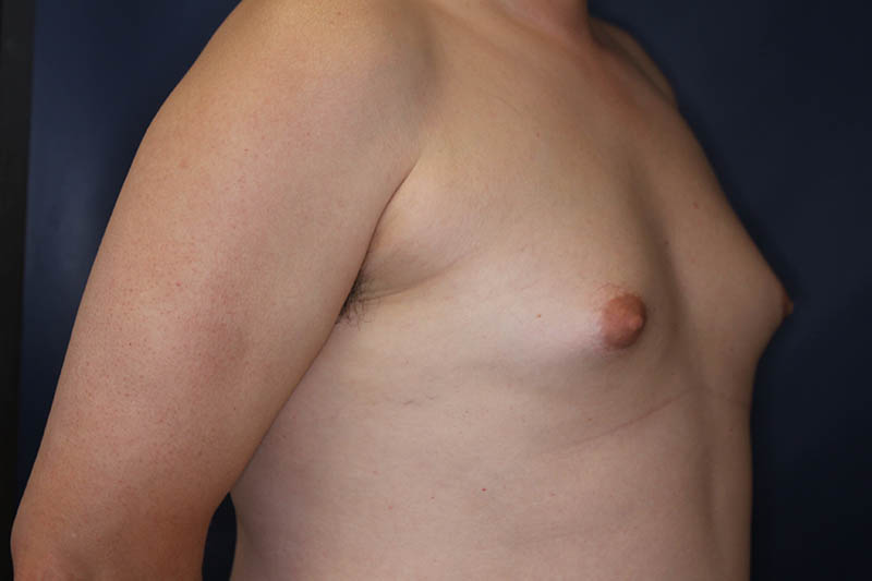 Male Body Enhancement Before & After Image