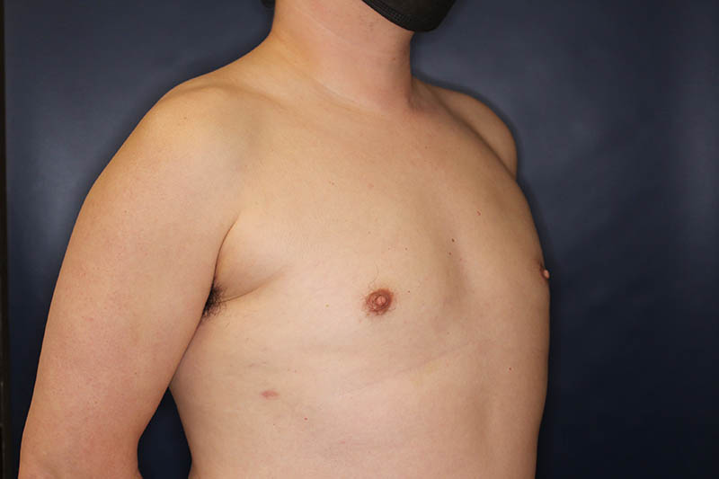 Male Body Enhancement Before & After Image