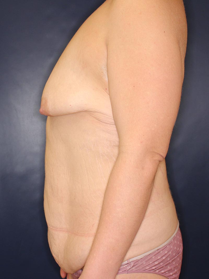 Mommy Makeover Before & After Image