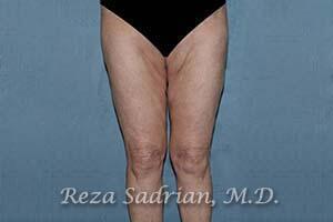 Thigh Lift Before & After Image