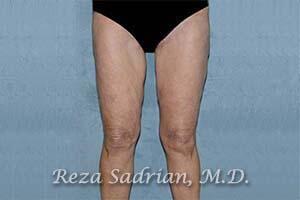 Thigh Lift Before & After Image