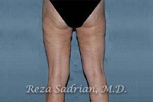 Thigh Lift Before & After Image