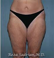 Thigh Lift Before & After Image