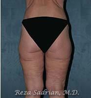 Thigh Lift Before & After Image