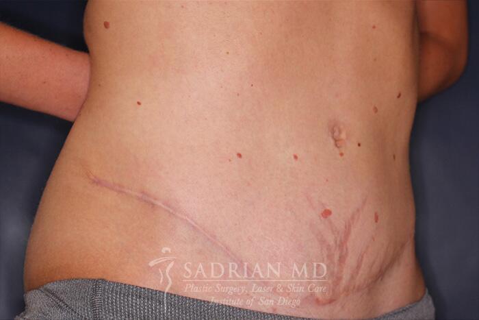 Tummy Tuck Before & After Image