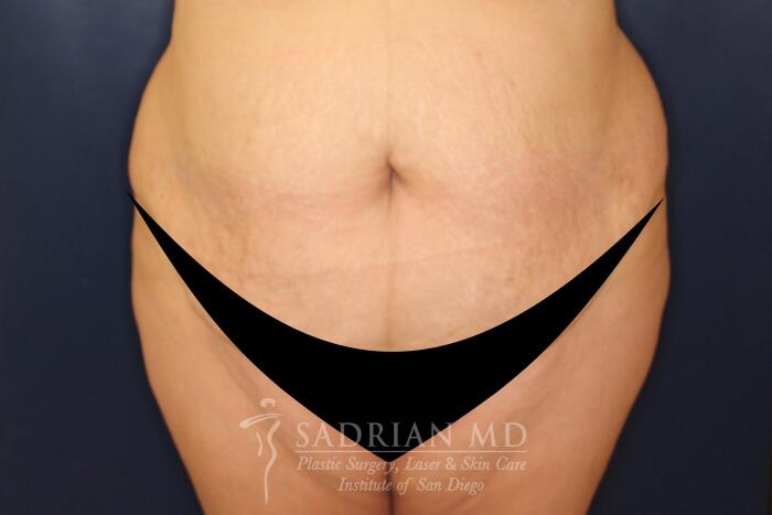 Tummy Tuck Before & After Image