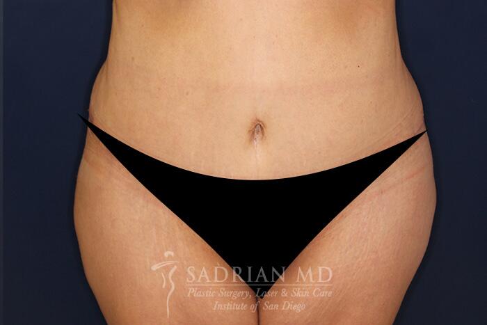 Tummy Tuck Before & After Image