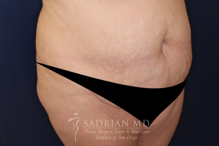 Tummy Tuck Before & After Image