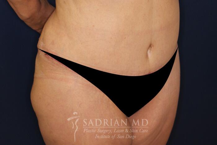 Tummy Tuck Before & After Image