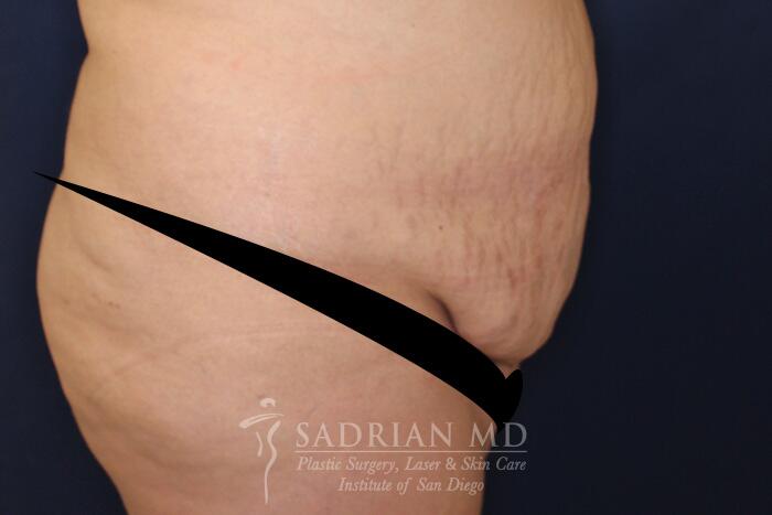 Tummy Tuck Before & After Image