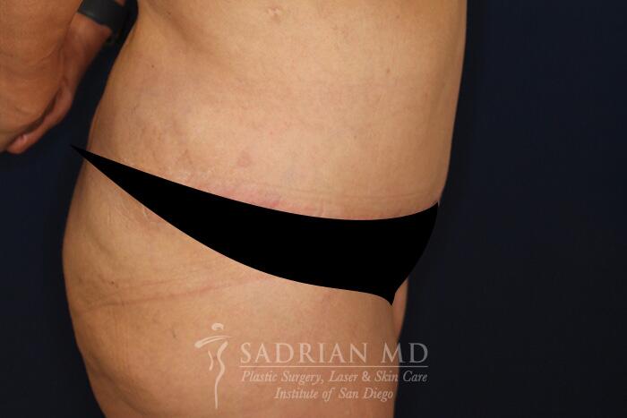 Tummy Tuck Before & After Image