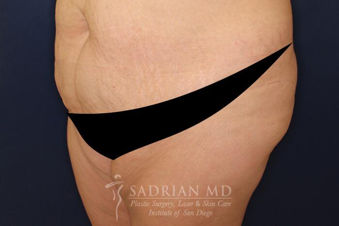 Tummy Tuck Before & After Image