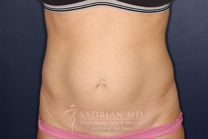 Tummy Tuck Before & After Image