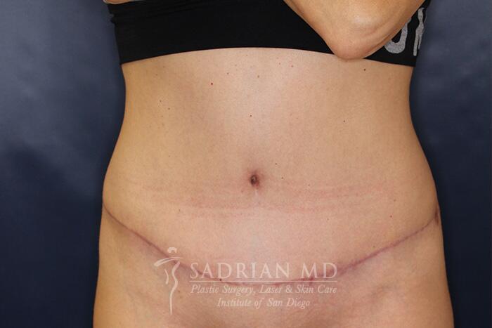 Tummy Tuck Before & After Image