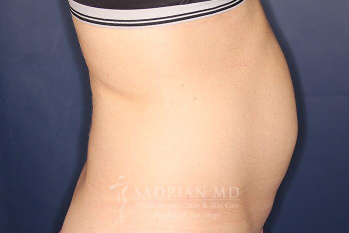 Tummy Tuck Before & After Image